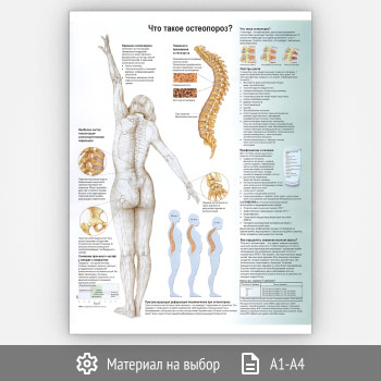 Плакат «Что такое остеопороз?» (ЗОЖ-02, 1 лист)